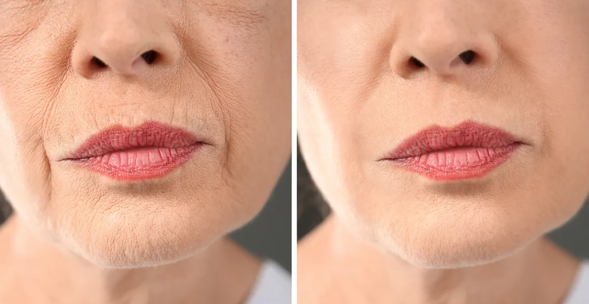 Skin Rejuvenation