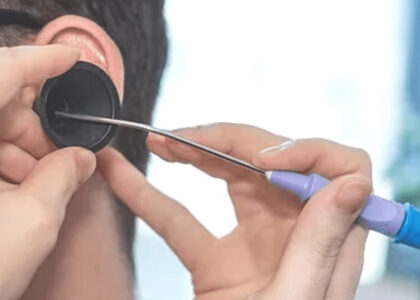 A close-up image showing a specialized microsuction device used for gentle and precise earwax removal, representing the advanced technology employed at North Harrow Pharmacy for effective ear care.